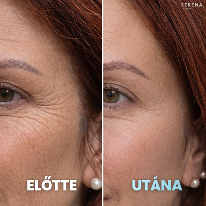 SERENA Bőrfeszesítő és Ráncfinomító készülék