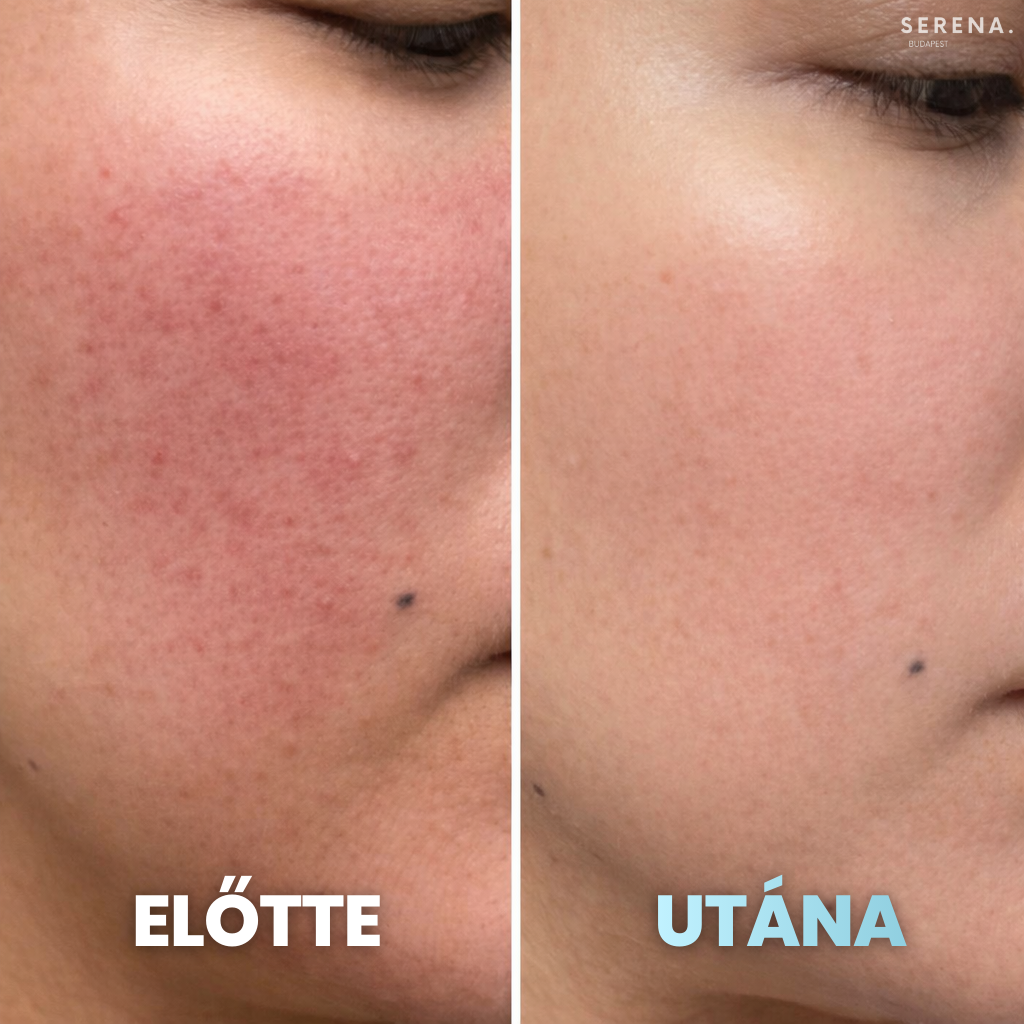 SERENA Bőrfeszesítő és Ráncfinomító készülék