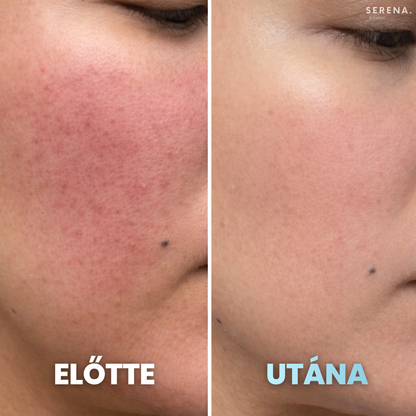 SERENA Bőrfeszesítő és Ráncfinomító készülék