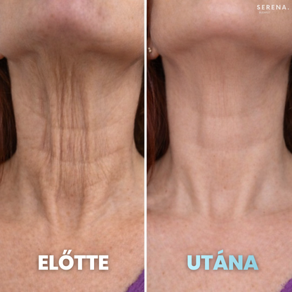 SERENA Bőrfeszesítő és Ráncfinomító készülék