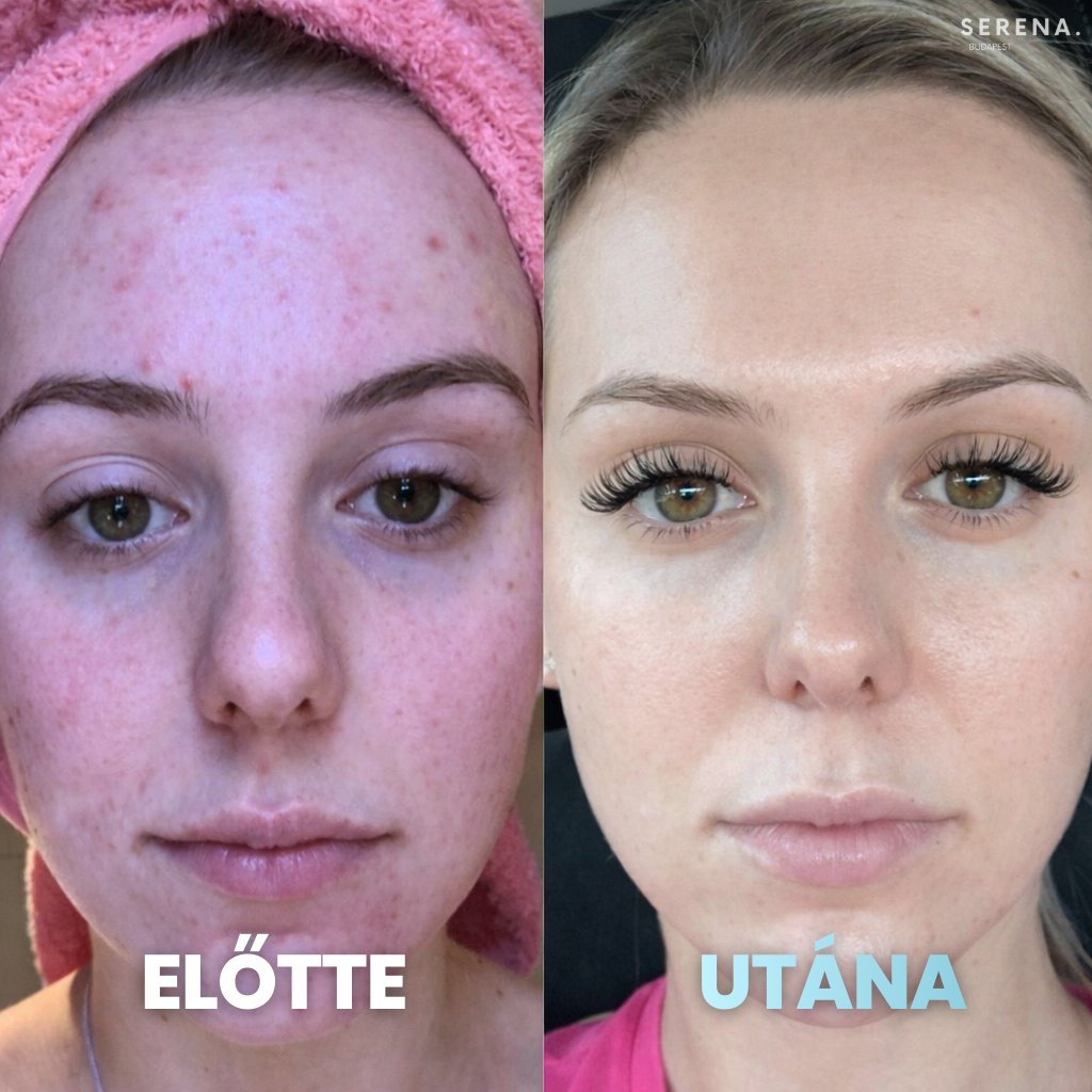 SERENA Bőrfeszesítő és Ráncfinomító készülék