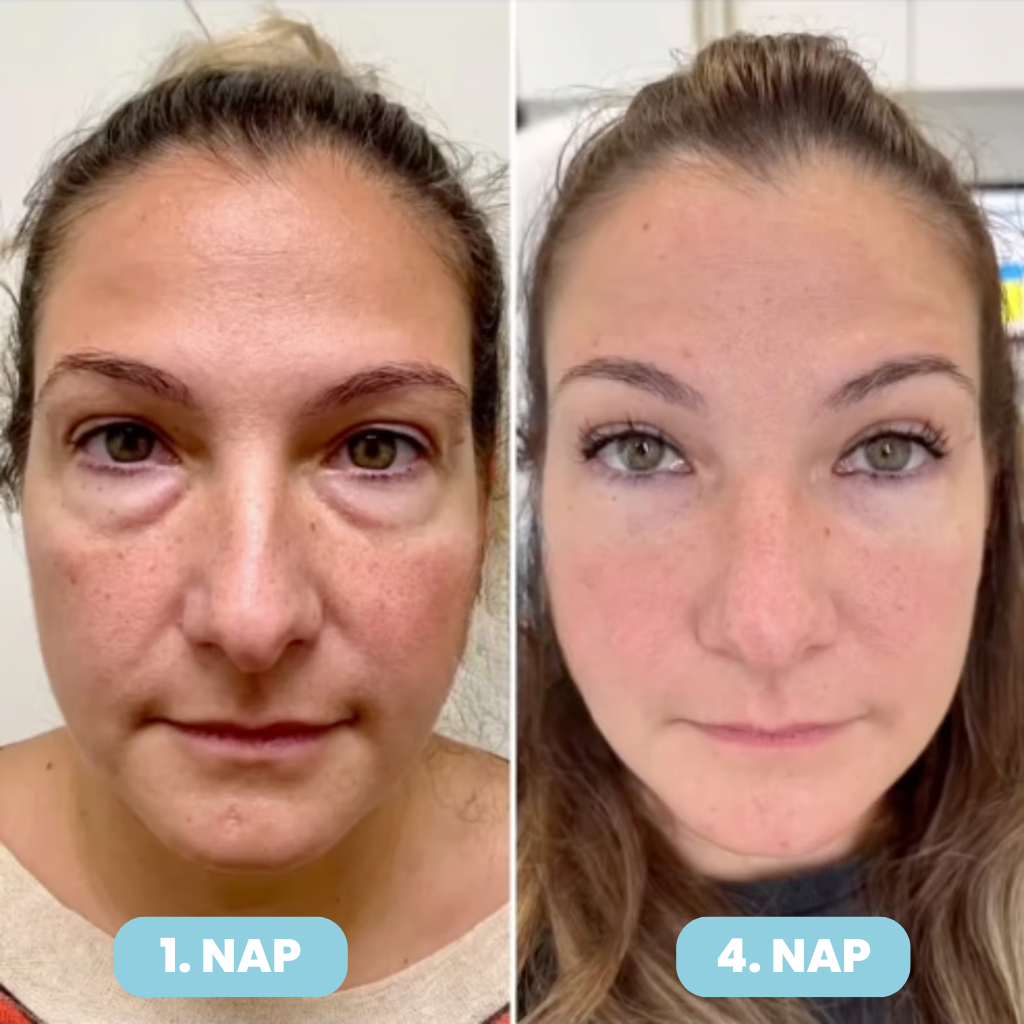 SERENA Bőrfeszesítő Maszk – Ráncfinomító Technológiával