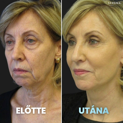 SERENA Bőrfeszesítő és Ráncfinomító készülék